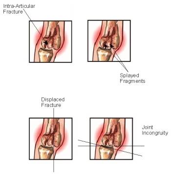 medical illustration showing a broken pinky finger