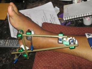 photo showing external fixation for a broken ankle