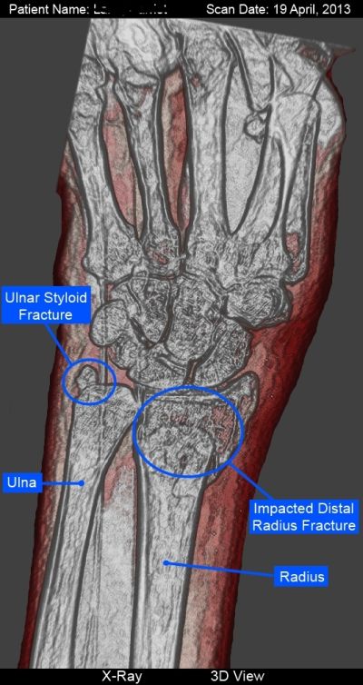 3-D color x-ray of Ulnar & radial fractures before surgery
