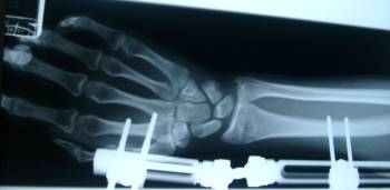 AP view x-ray of broken wrist with external fixation