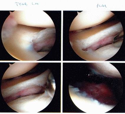 Achilles tendon rupture tear seen during surgery