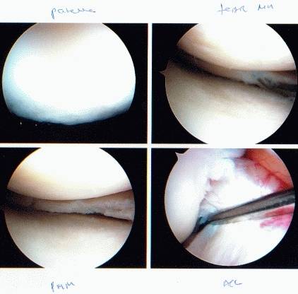 achilles tendon tear seen during surgery-another view