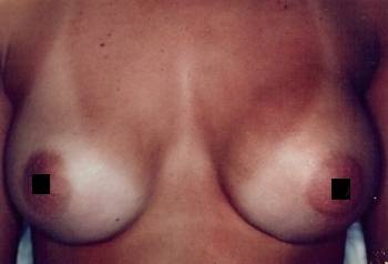 photo of a breast implant rupture from a car accident shows the right breast implant leak