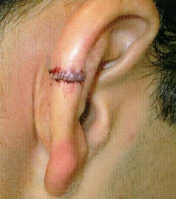 ear injury after surgery