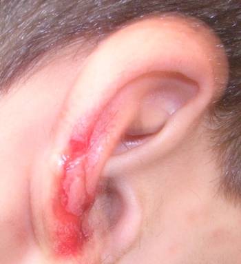ear laceration injury before surgery