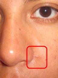 scar on nose