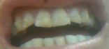 Damaged teeth