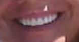 Damaged teeth after dental work