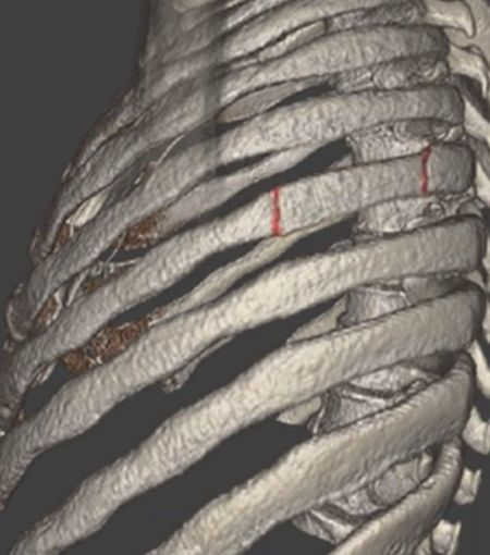 3-D color MRI showing displaced rib fractures
