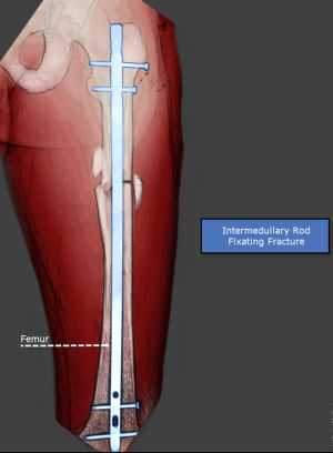 broken femur fracture with internal fixation