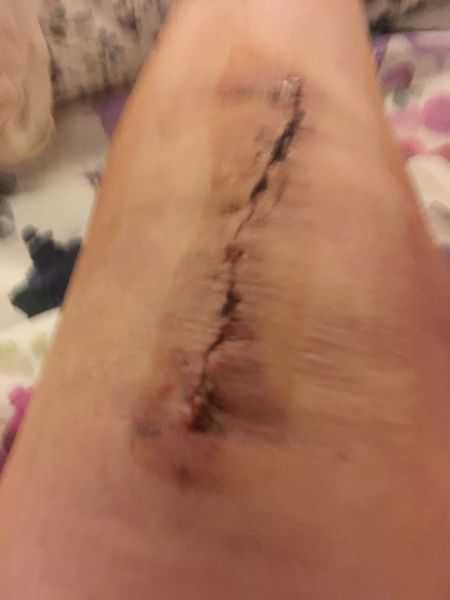 Knee Replacement scar right after surgery-this was a client of the New York knee injury lawyers Personal Injury Dream Team™ at 1-800-HURT-911® 