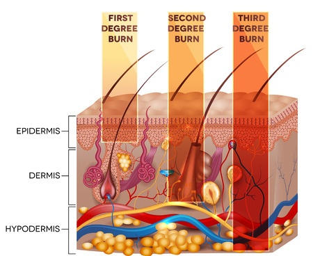 graphic image showing the severity of first, second and third degree burn injuries