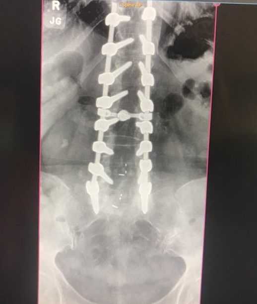 lower back spine surgery hardware