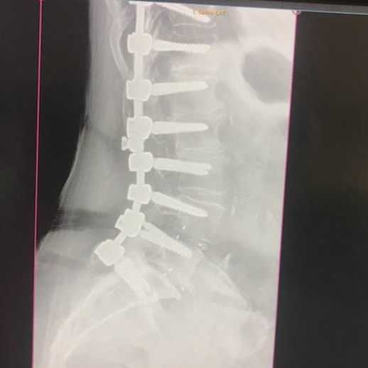 lower back spine surgery hardware side view