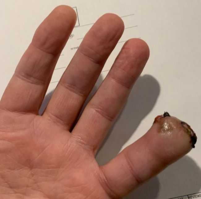 partial finger amputation from construction accident