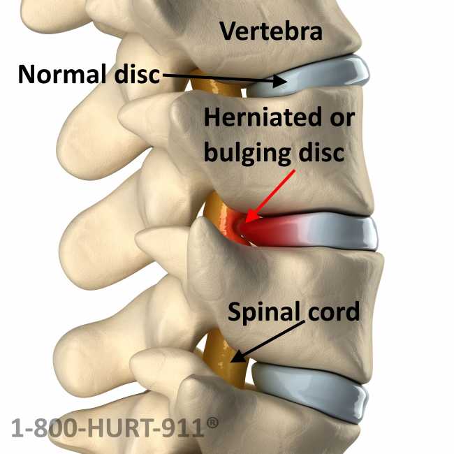 This image shows a herniated or bulging disc pinching the spinal cord causing neck or back pain shown by the neck and back injury lawyers at 1-800-HURT-911®