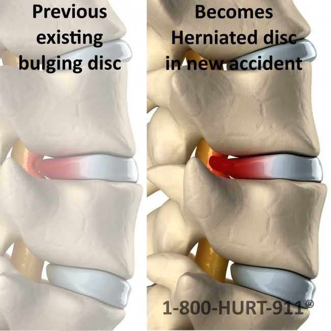 pre existing neck injury comparison with new neck injury that's worse in subsequent second accident