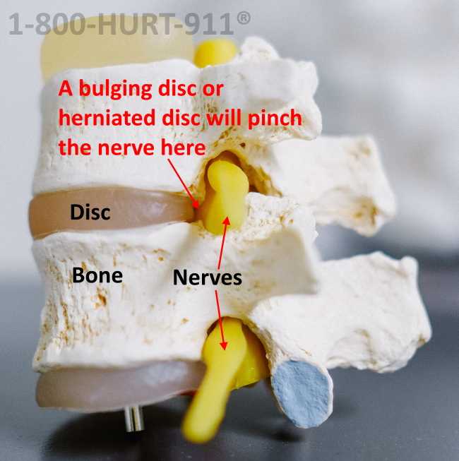 photo of a cross section of the spine showing where a herniated disc will pinch the nerve shown by the neck and back injury lawyers at 1-800-HURT-911®